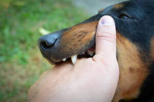 Hand Bitten by a Dog